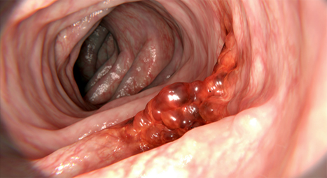 대장암으로 진행 가능한 질환